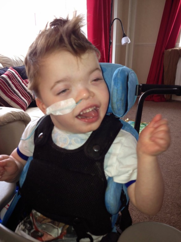 NG tube used to vent his stomach